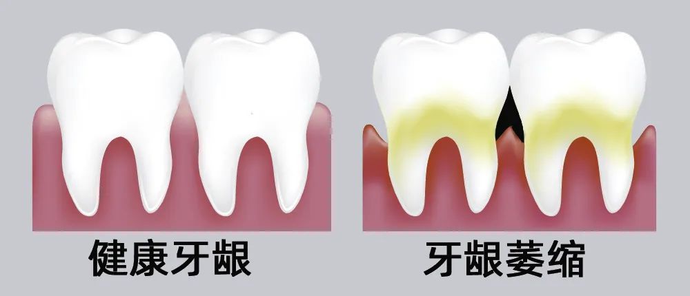 牙縫大露出“黑三角”，既塞牙又難看！還能恢復(fù)嗎？